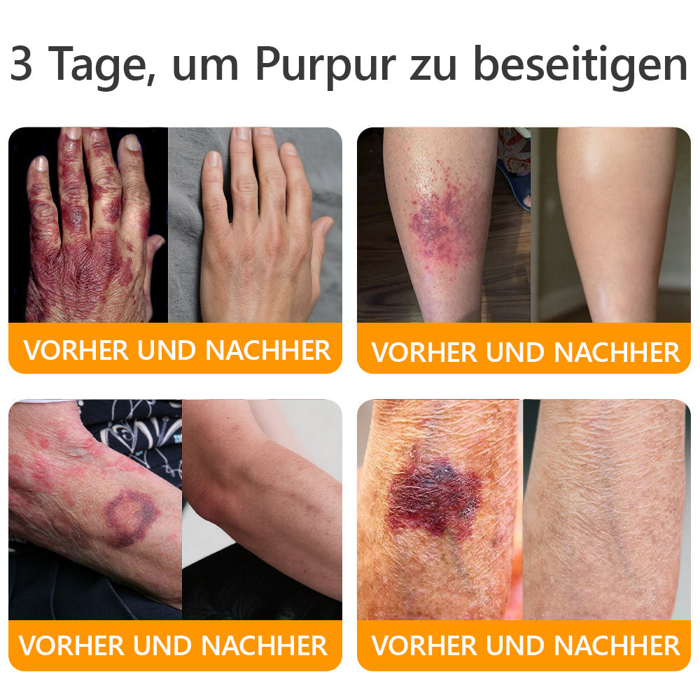 Hergestellt in Deutschland ✨AРKAРК™ Bienengift Umfassende Creme – Anti-Aging, Feuchtigkeitsspendend, Hautreparatur, Hautbildverbesserung, Akne- und Pigmentfleckenbehandlung, Warzen- und Muttermalentfernung, Linderung bei Psoriasis