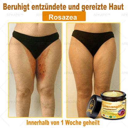 Hergestellt in Deutschland ✨AРKAРК™ Bienengift Umfassende Creme – Anti-Aging, Feuchtigkeitsspendend, Hautreparatur, Hautbildverbesserung, Akne- und Pigmentfleckenbehandlung, Warzen- und Muttermalentfernung, Linderung bei Psoriasis