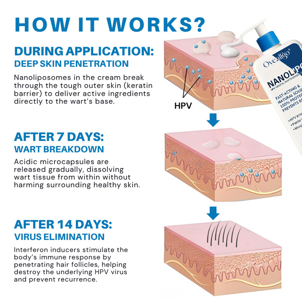 💪Oveallgo® NanoLipo HPV Genital Warts Eraser Cream