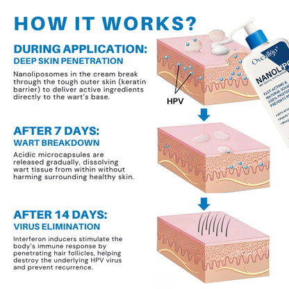 💪Oveallgo® NanoLipo HPV Genital Warts Eraser Cream